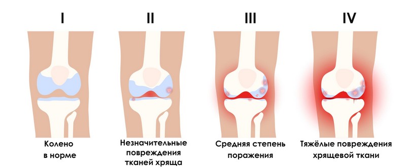 Дегенеративные изменения в суставах прогрессируют годами
